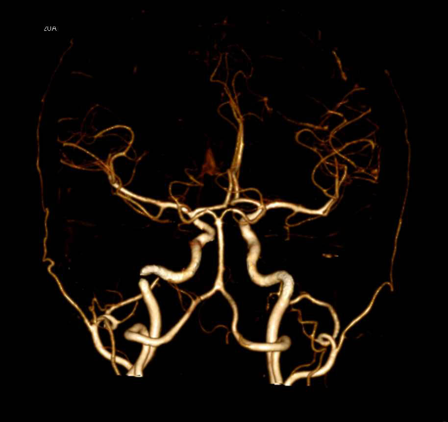 CTA of the Circle of Willis (COW) - CTisus CT Scan