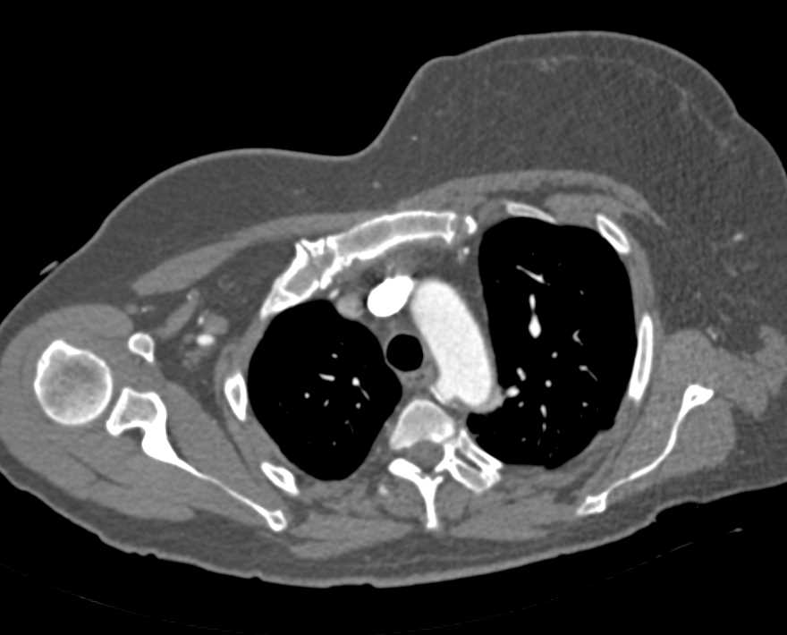 Graft from Right Subclavian Artery to the Carotid Artery - CTisus CT Scan