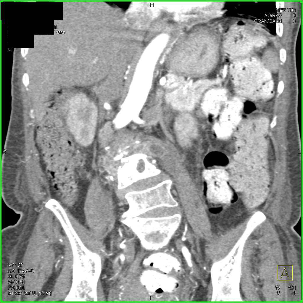 Osteomyelitis L-Spine - CTisus CT Scan