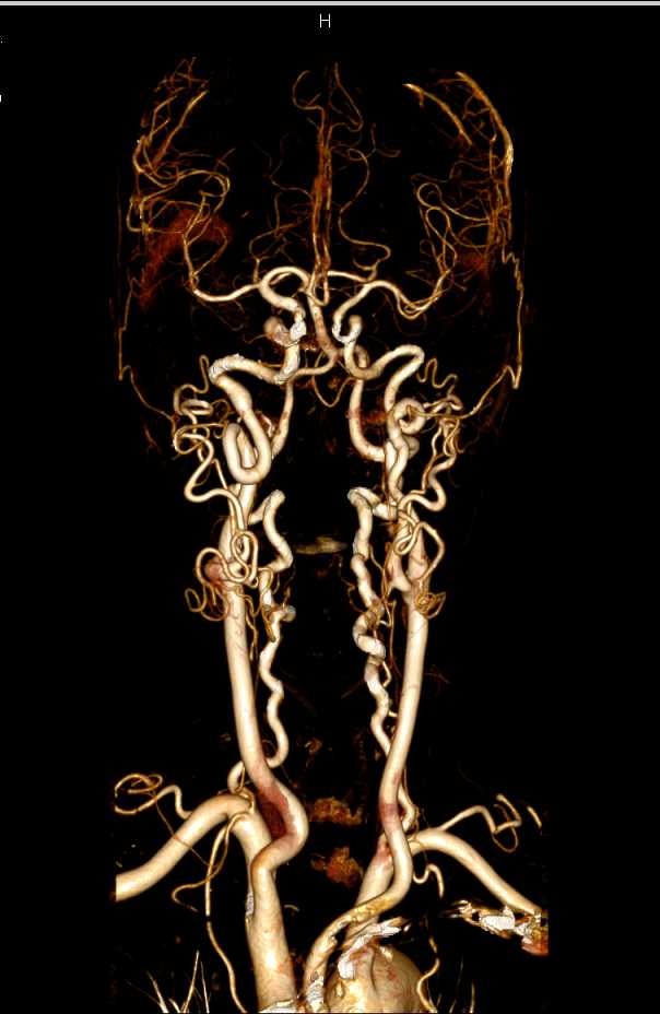 CTA of Carotid Arteries and Circle of Willis (COW) - CTisus CT Scan