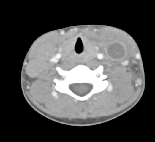 Jugular Vein Thrombosis and Neck Abscess and Septic Emboli - CTisus CT Scan