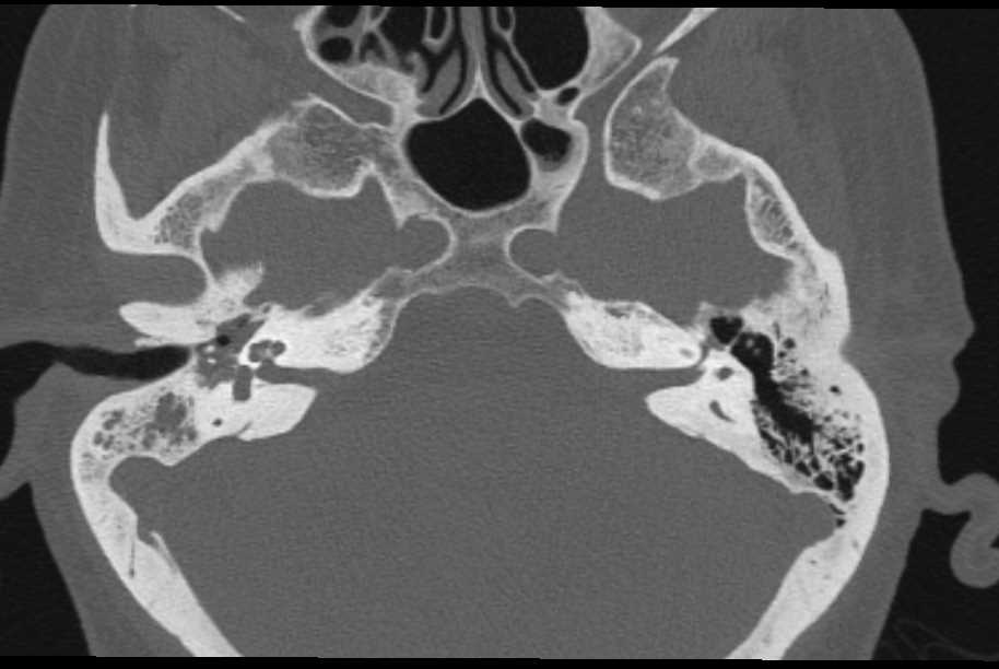 Infection of the Inner Ear - CTisus CT Scan