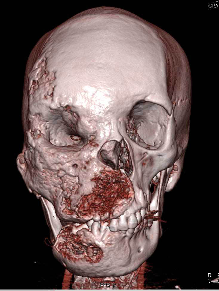 Fibrous Dysplasia of the Skull - CTisus CT Scan