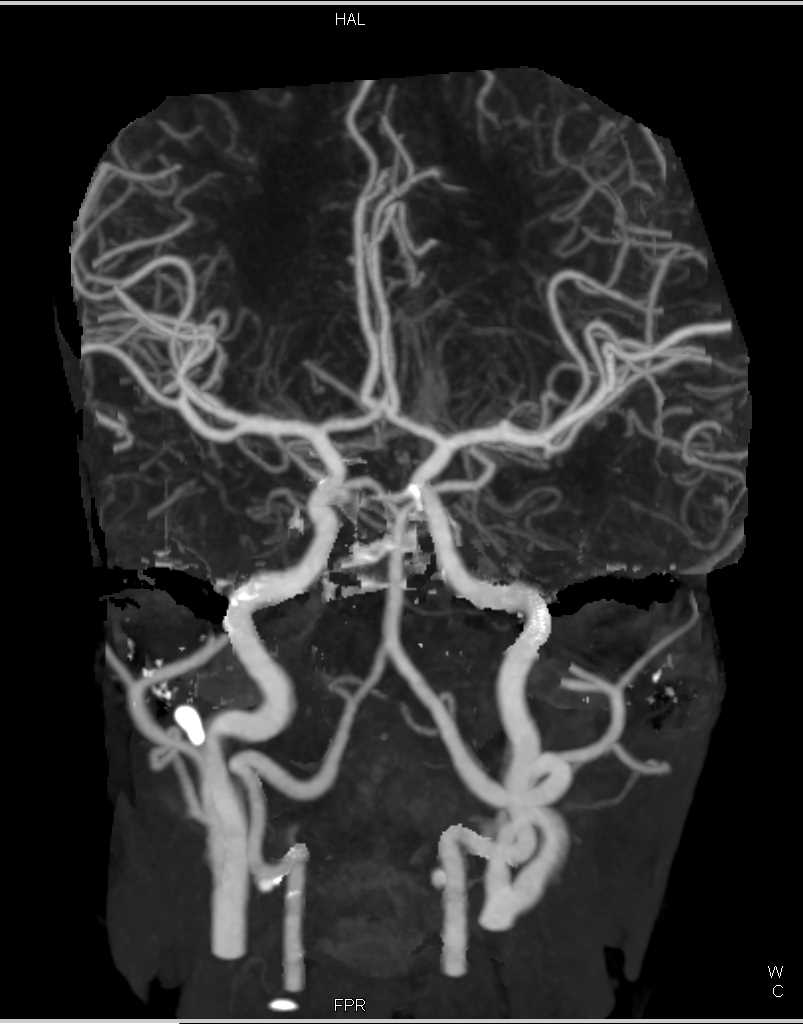 Carotid Artery Disease - CTisus CT Scan