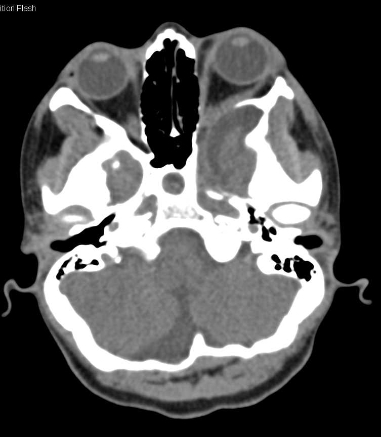 3D Base of Skull and Spine - CTisus CT Scan