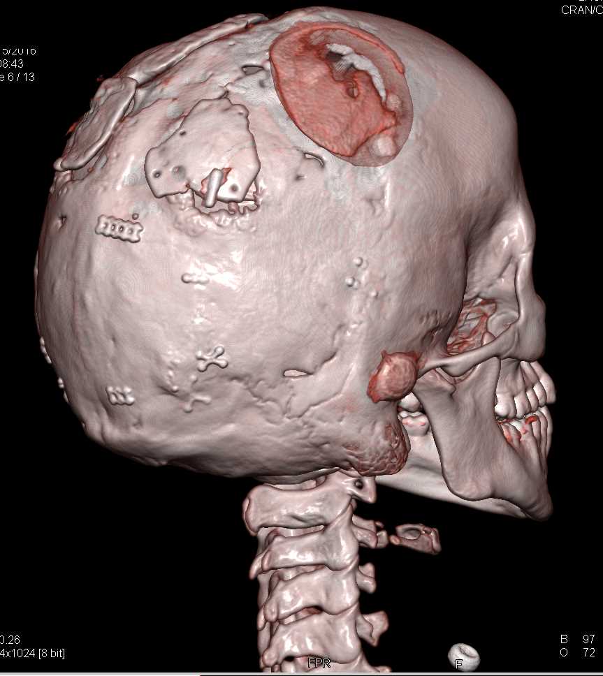 3D Skull with Volume Rendering - CTisus CT Scan