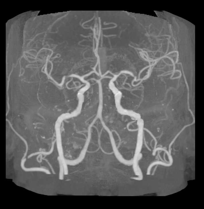 Normal Circle of Willis and Carotid Artery Stenosis - CTisus CT Scan