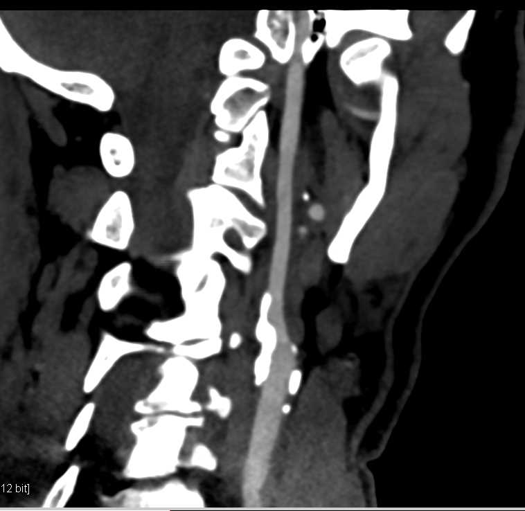 Carotid Artery Stenosis - CTisus CT Scan