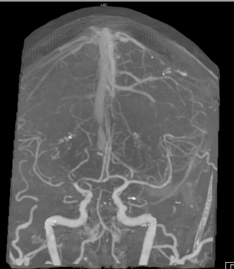 Mass Effect due to Tumor Edema - CTisus CT Scan