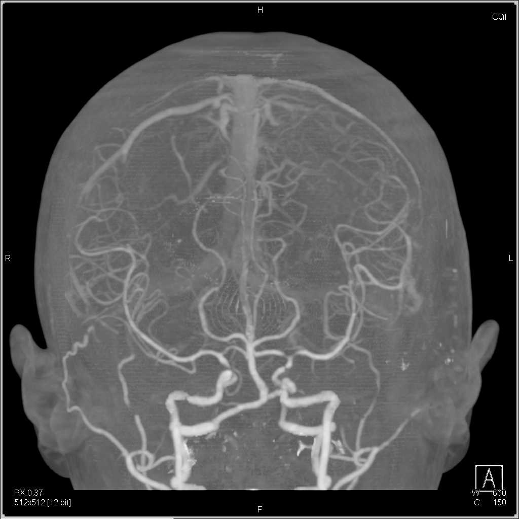 Perfusion Imaging of the Brain - CTisus CT Scan