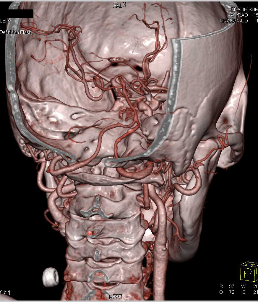 CTA of the Circle of Willis - CTisus CT Scan