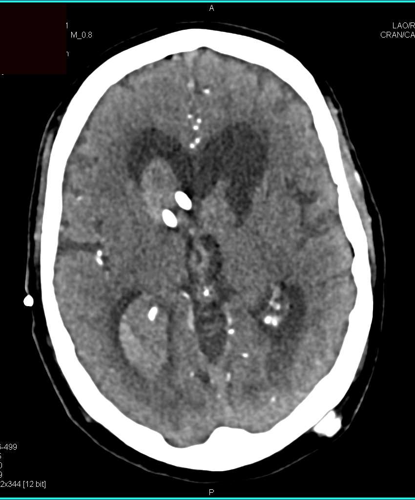 Intraventricular Bleed - CTisus CT Scan