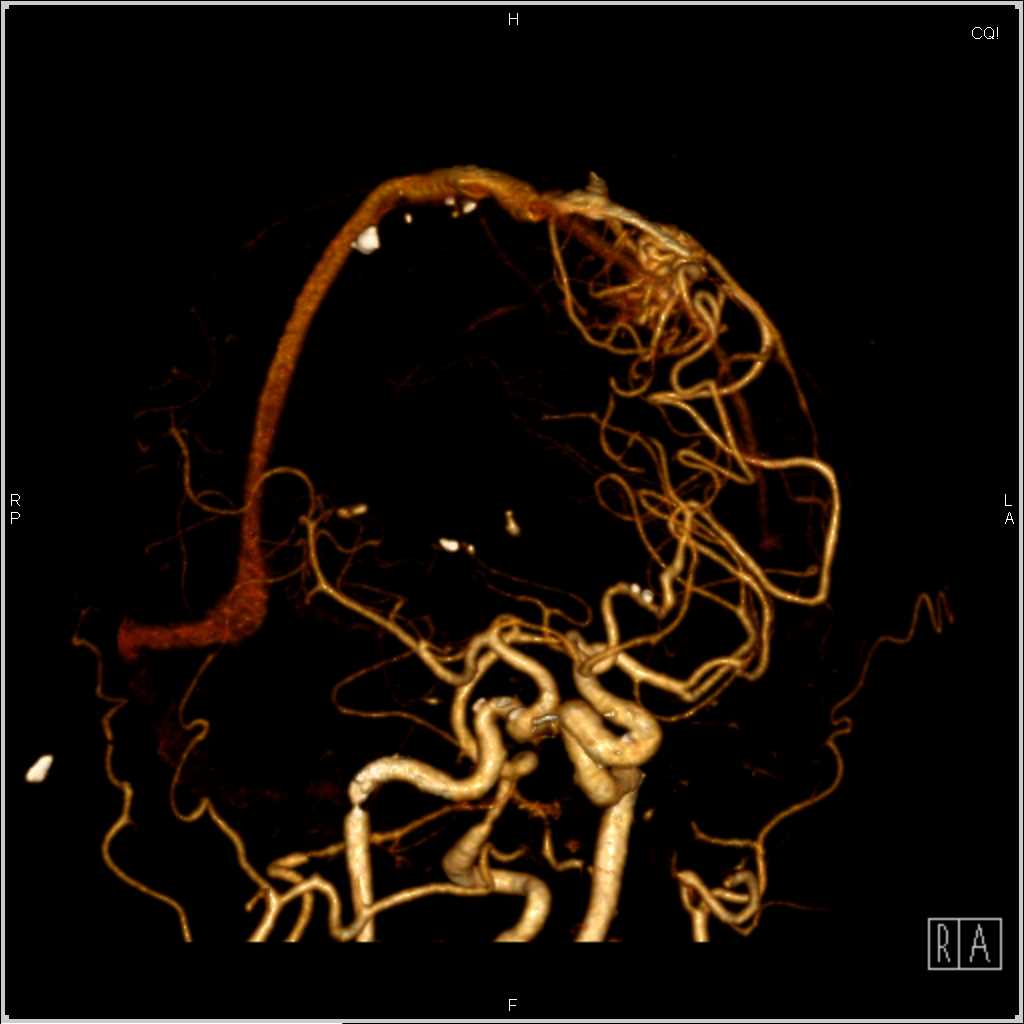CTA with AV Fistulae - CTisus CT Scan