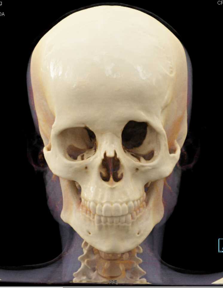 Cinematic Rendering of the Skull - CTisus CT Scan