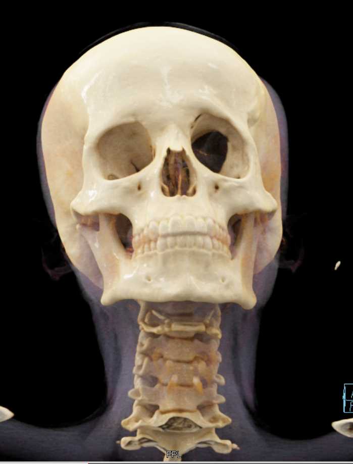 Cinematic Rendering of the Skull and Facial Bones - CTisus CT Scan