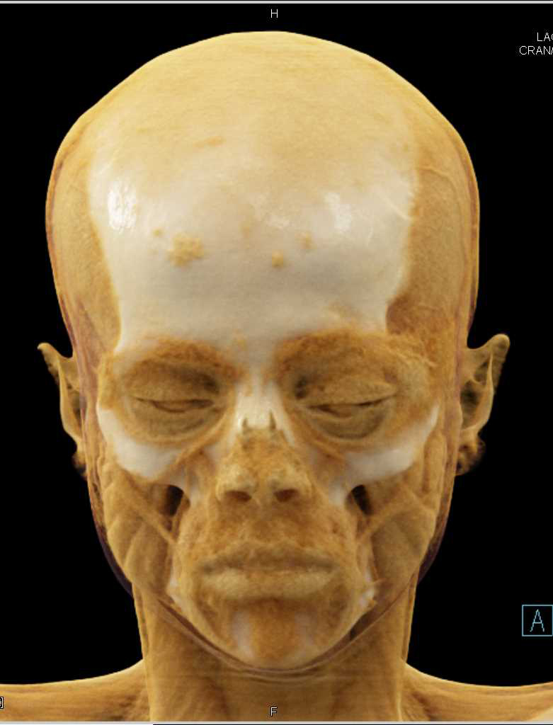 Cinematic Rendering of the Skull - CTisus CT Scan