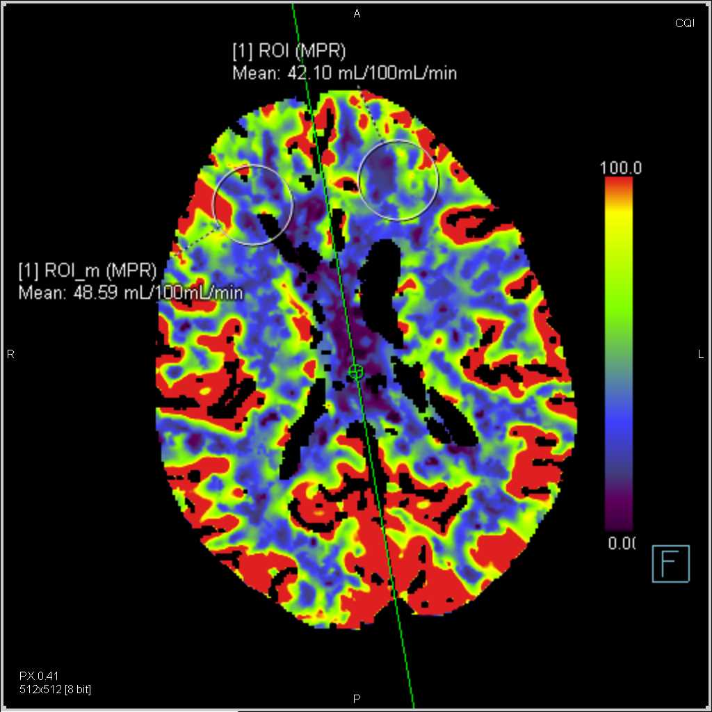 Perfusion CT of the Brain for Stroke - CTisus CT Scan
