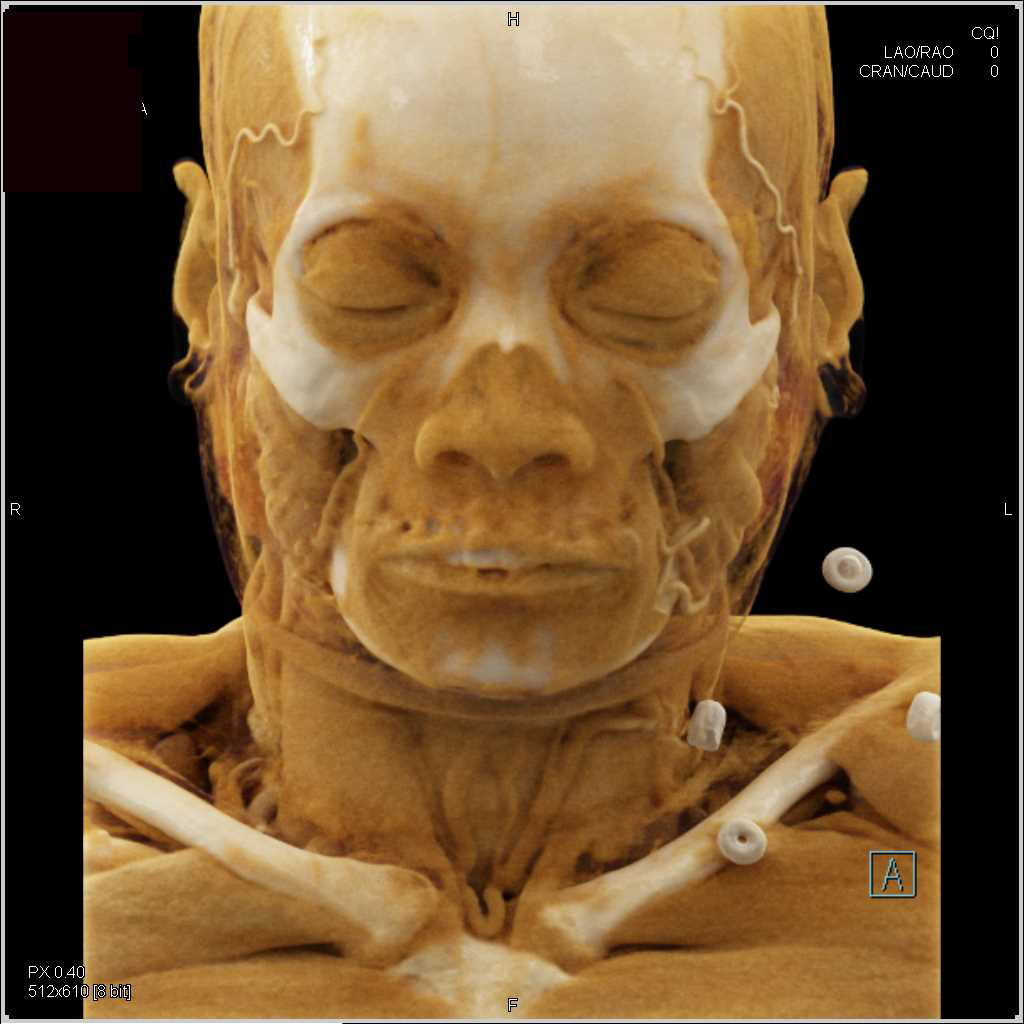 Normal Cranial Anatomy with Cinematic Rendering - CTisus CT Scan