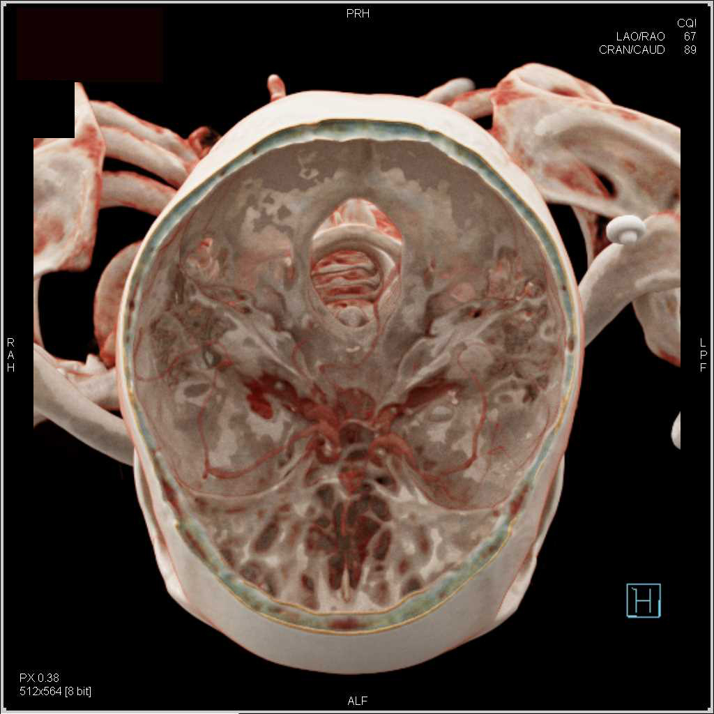 Normal Cranial Anatomy with Cinematic Rendering - CTisus CT Scan