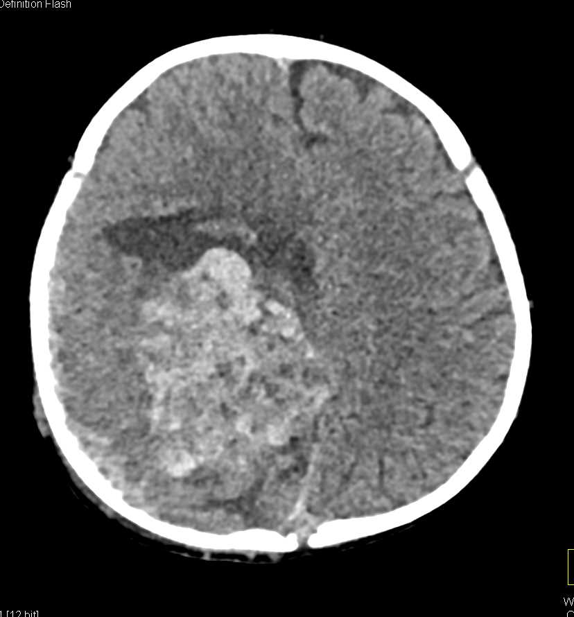 Cranial Tumor with Bony Involvement and Bleeding - CTisus CT Scan