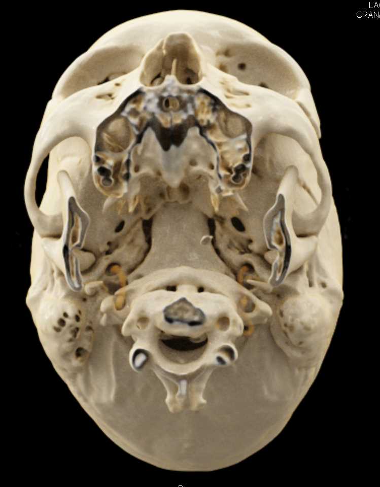 Orbital Fractures Post Trauma - CTisus CT Scan