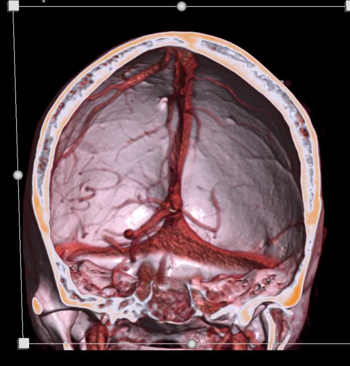 CTA with Vessel Occlusion on the Left Side - CTisus CT Scan