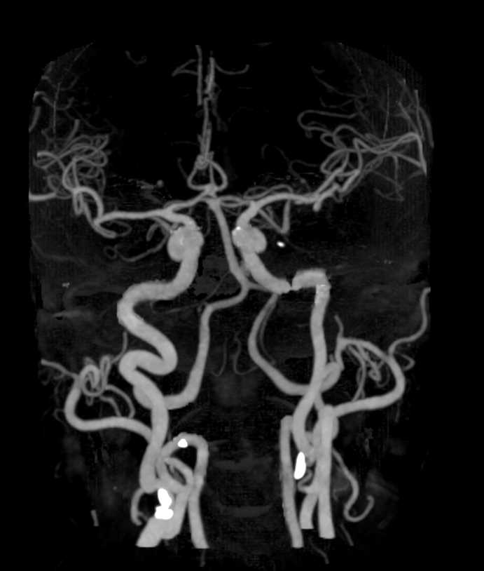 Carotid CTA - CTisus CT Scan