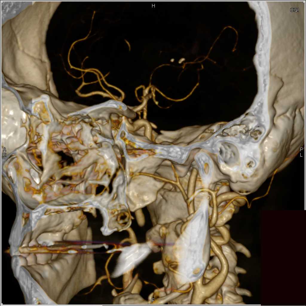 Normal Carotid Circulation - CTisus CT Scan