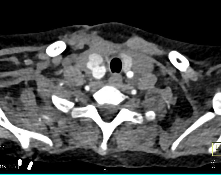 Pseudoaneurysm Carotid Artery - CTisus CT Scan