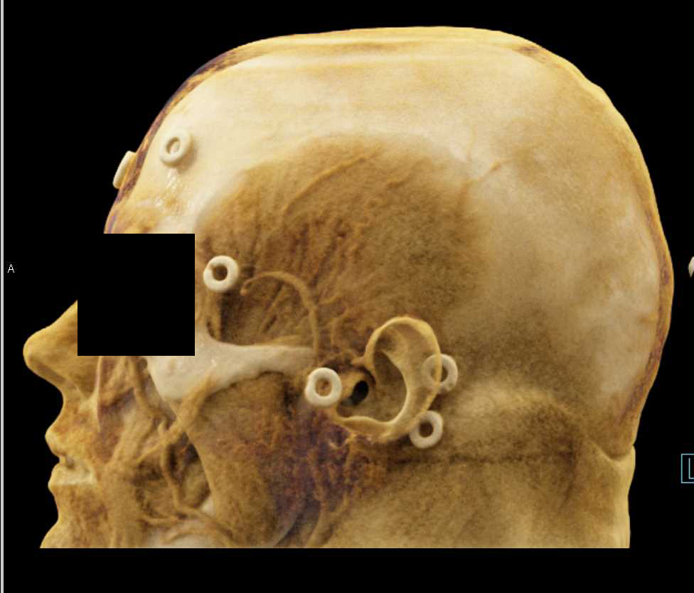 Osteoma Skull - CTisus CT Scan