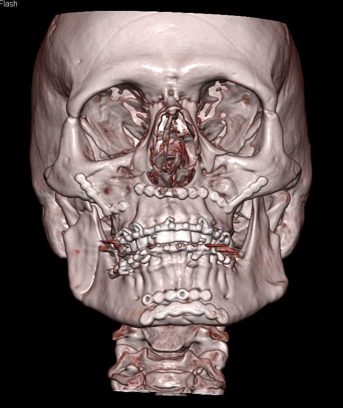 Repair of Orbital Fractures - CTisus CT Scan