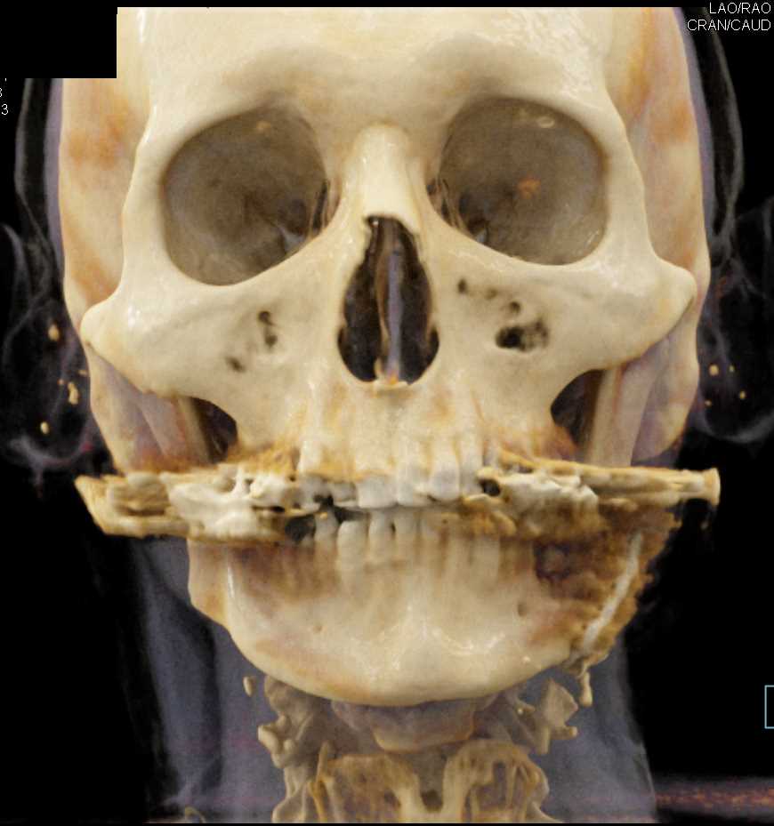 Post Fascial Trauma Repair - CTisus CT Scan