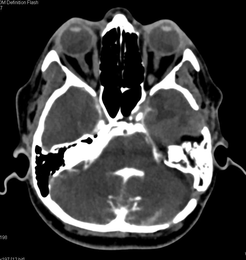 Post CT Myelogram - CTisus CT Scan