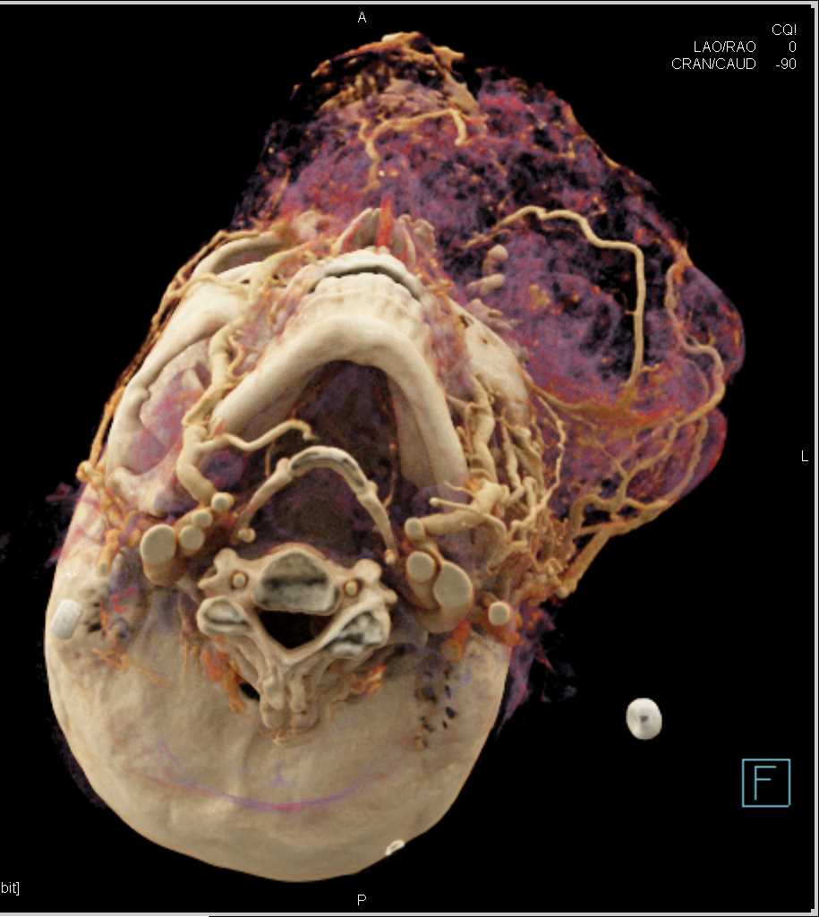 Bone Destruction by Aggressive Tumor - CTisus CT Scan