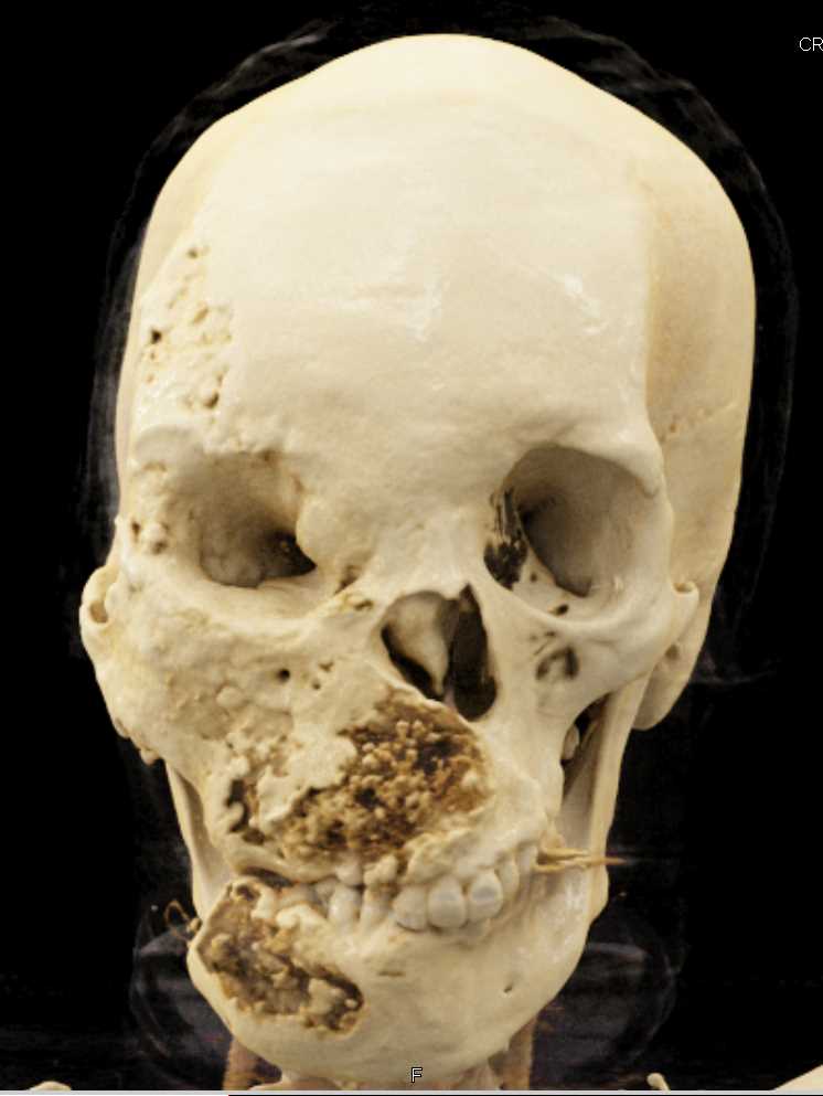 Fibrous Dysplasia of the Skull with Cinematic Rendering - CTisus CT Scan