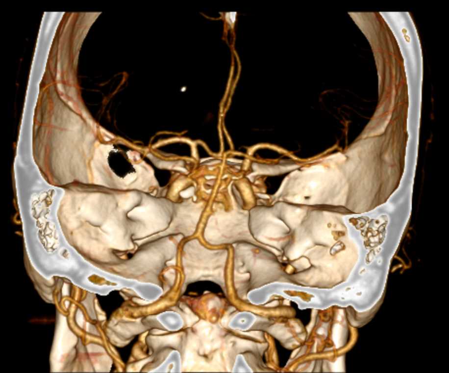 Circle of Willis - CTisus CT Scan