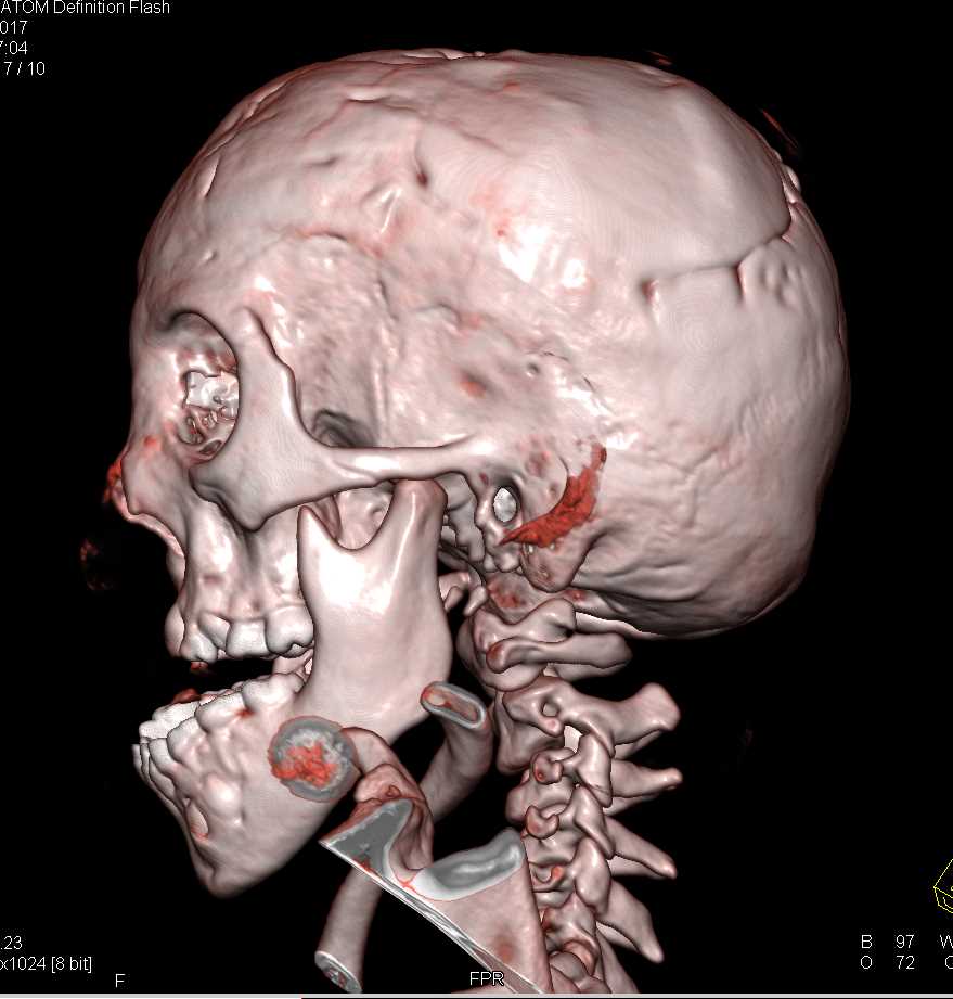 Craniofacial Deformity - CTisus CT Scan