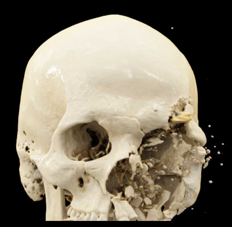 Orbital Trauma - CTisus CT Scan