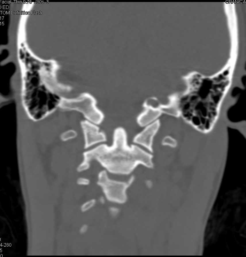 Left Mandible Fracture - CTisus CT Scan