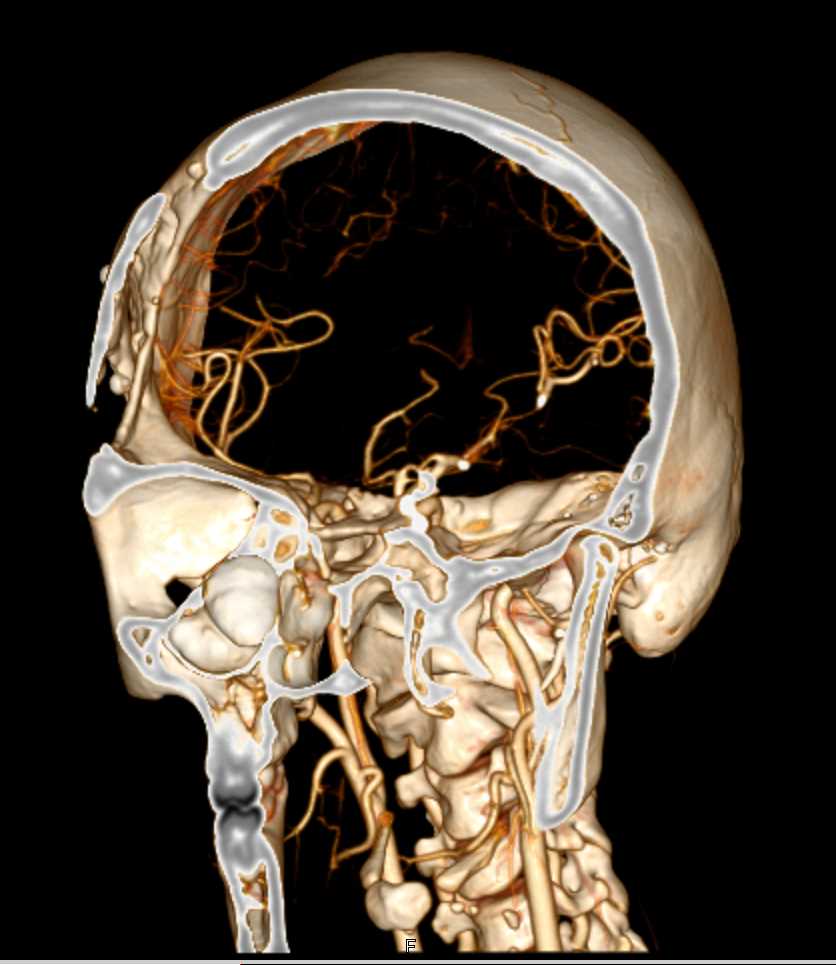 CTA of the Circle of Willis - CTisus CT Scan