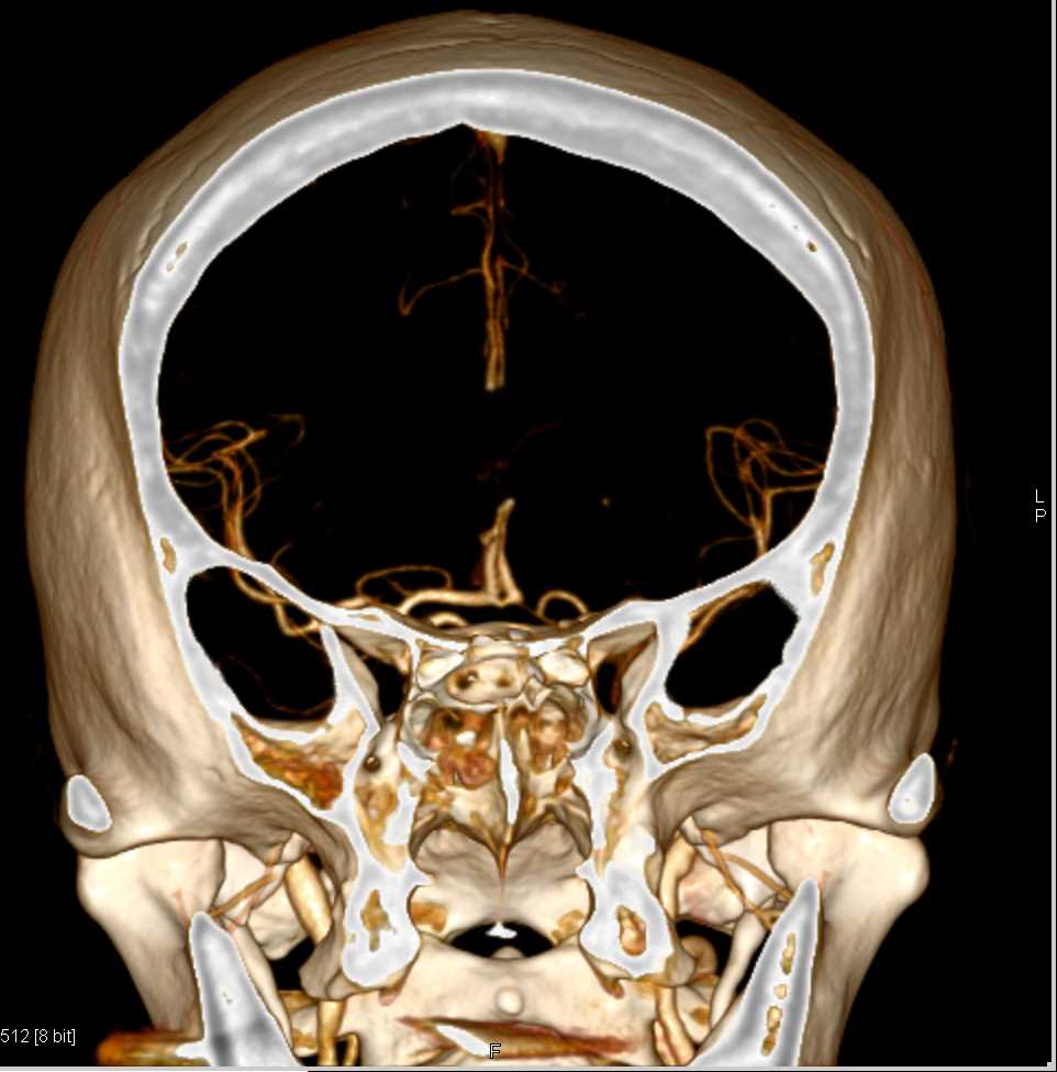 Circle of Willis - CTisus CT Scan