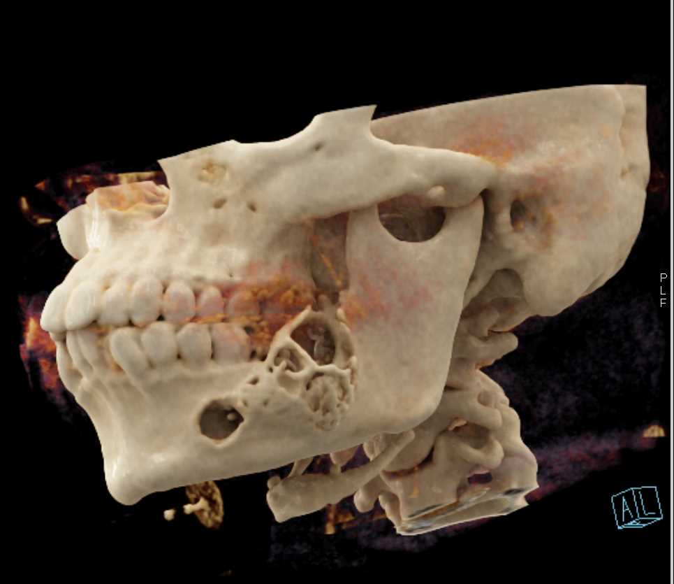 Amelioblastoma of the Mandible - CTisus CT Scan