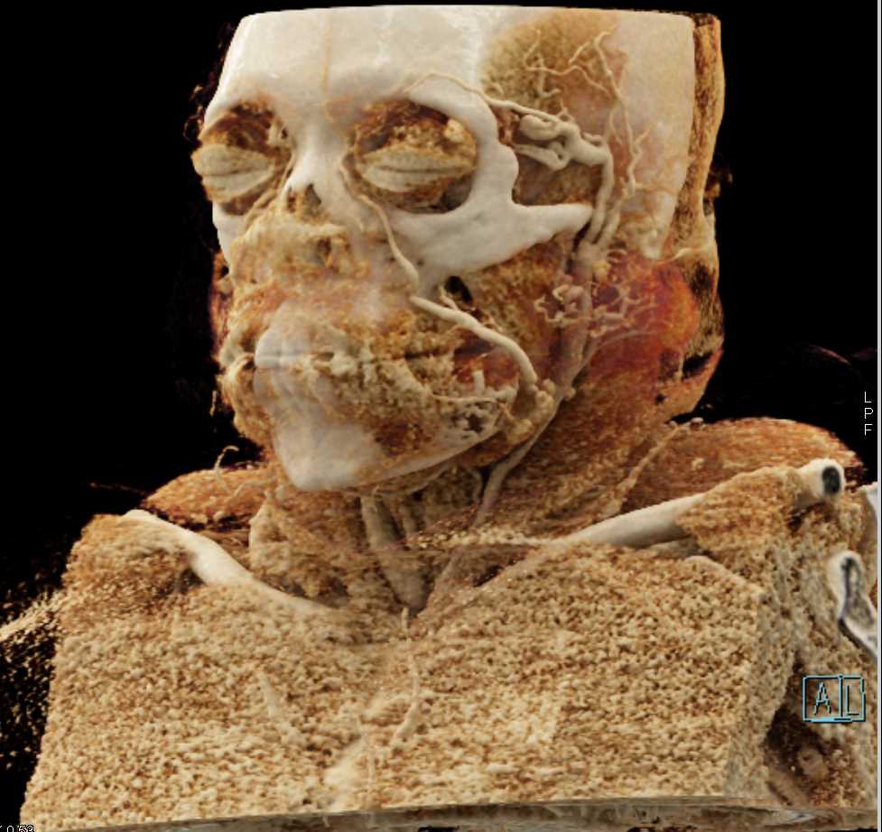 Ameloblastoma of the Mandible with Cinematic Rendering - CTisus CT Scan
