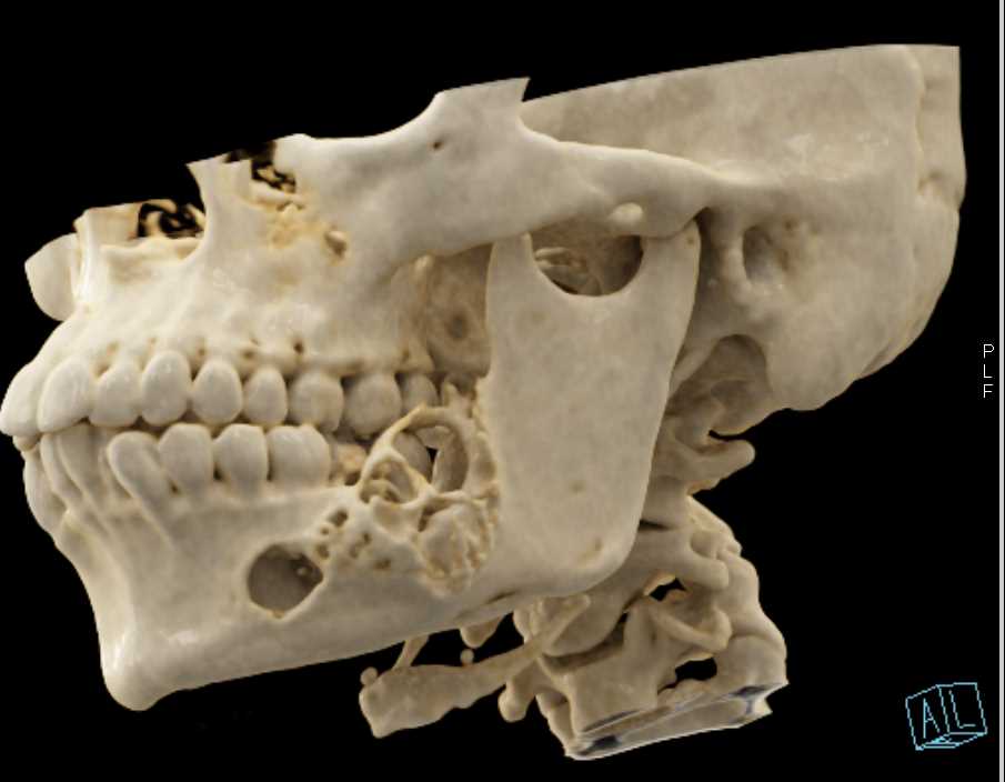 Ameloblastoma of the Mandible with Cinematic Rendering - CTisus CT Scan