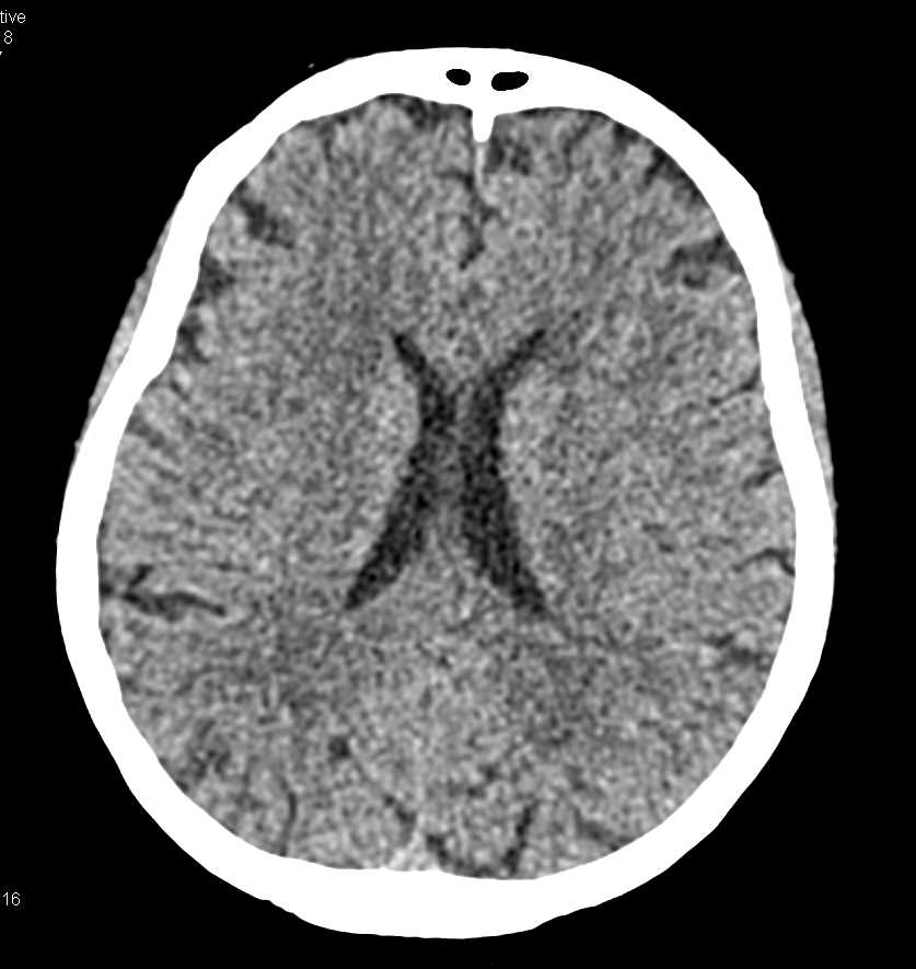 CT Brain Without Mass Effect - CTisus CT Scan