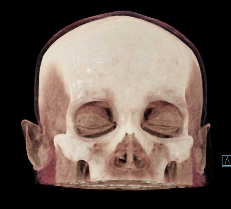 CT Brain with 3D Mapping - CTisus CT Scan