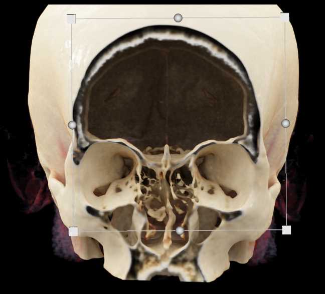 CT Brain with 3D Mapping - CTisus CT Scan
