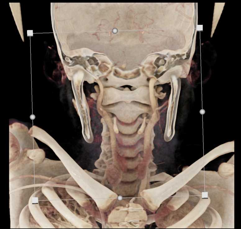 Ectopic Parathyroid Adenoma - CTisus CT Scan