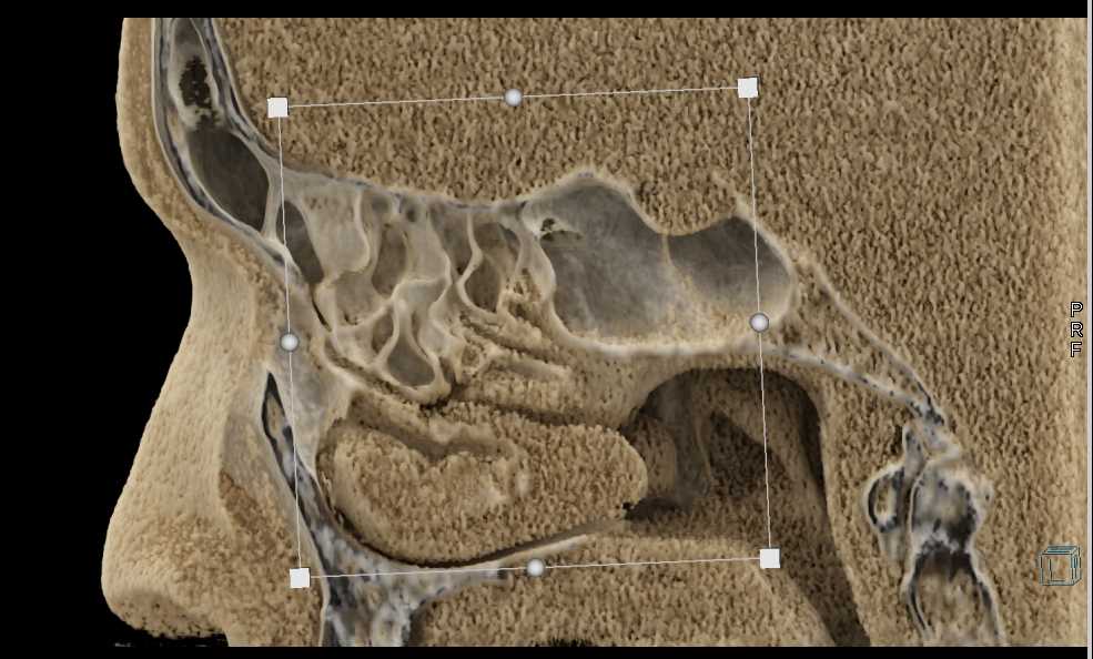 CR of the Sinuses - CTisus CT Scan