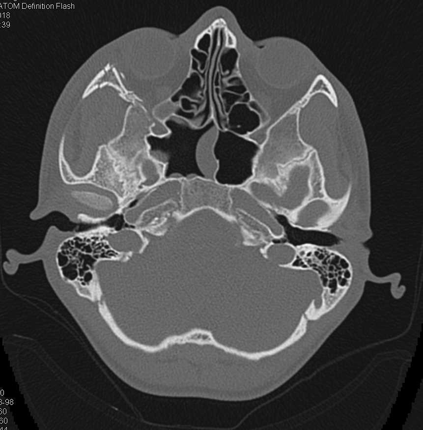 Right Orbital Fracture - CTisus CT Scan